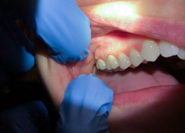 Best Emergency Tooth Extraction  in Benson, NC